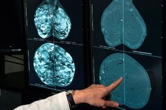 توصیههای مهم برای کاهش خطر ابتلا به سرطان