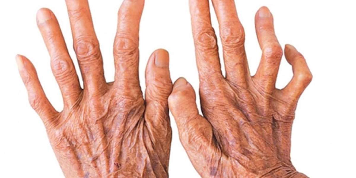 موارد ابتلا به جذام در ایران انگشت‌شمار است